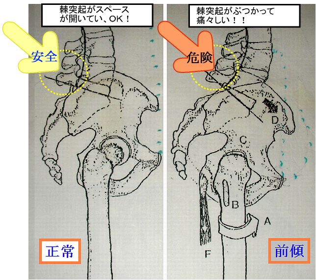 骨盤前傾で腰椎椎間板のくさび形化と棘突起のぶつかり.jpg