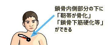 鎖骨下のしこり.jpg